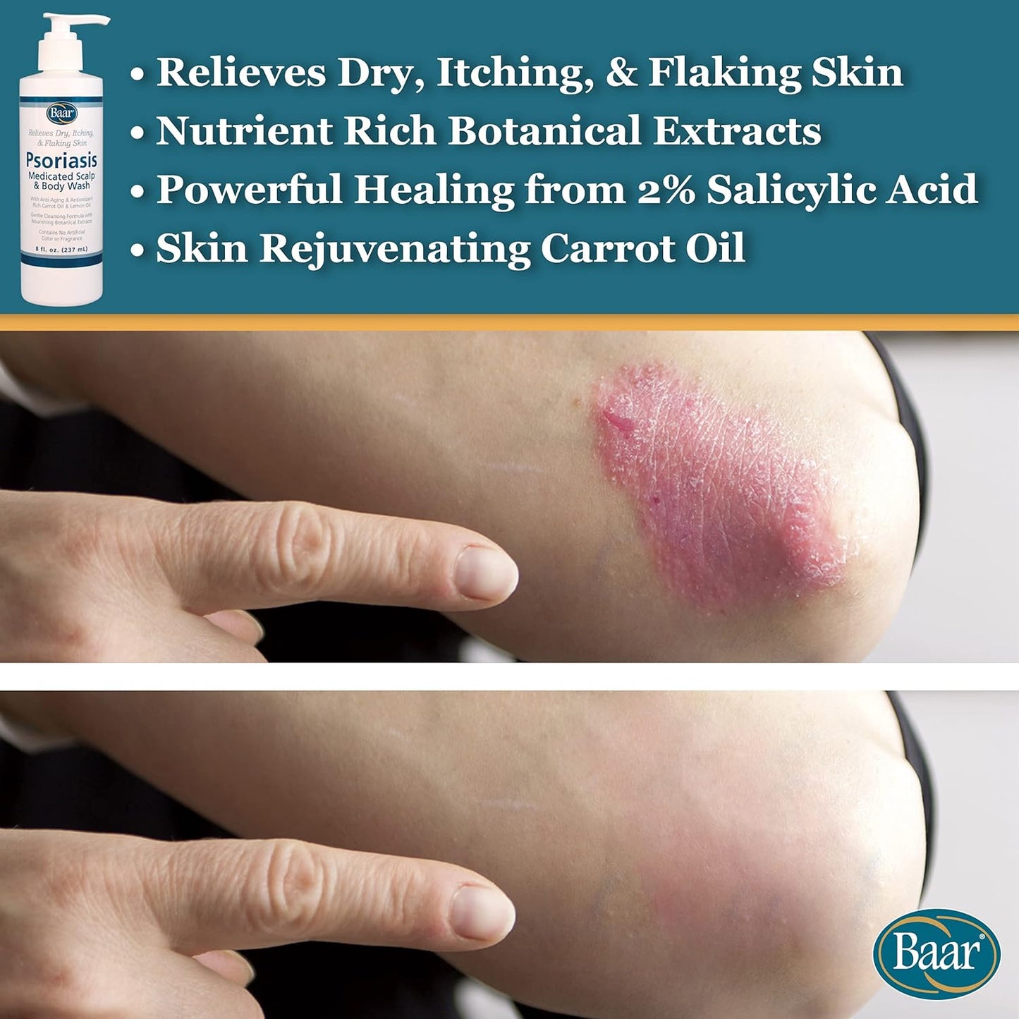 Psoriasis Therapeutic Scalp & Body Wash, Soothing Healing Formula with 2% Salicylic Acid and Antioxidant-Packed Botanicals like Carrot and Lemon Oil to Relieve Itchy, Dry Skin, 8 Fl Oz